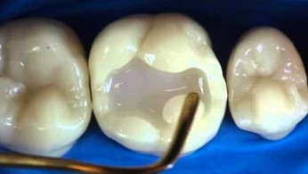 Odbudowanie zębów w technologii Smart Dentin Replacement