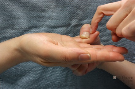 Rekonstrukcja zerwanego zginacza głębokiego palca